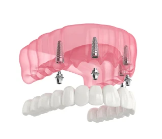 All-on-4 dental implants supporting a full arch of teeth, Garden City, New York