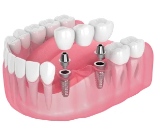 Implant-supported dental bridge illustration, Garden City, New York