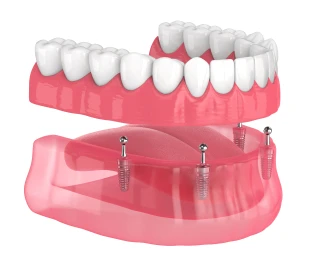 Implant-supported dentures with removable teeth, Garden City, New York