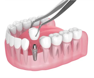 Single dental implant placement illustration, Garden City, New York